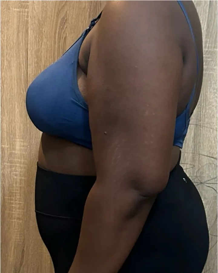 After. Side-profile torso photographs of a client in a blue sports bra and black shorts, taken against the same wooden wall.